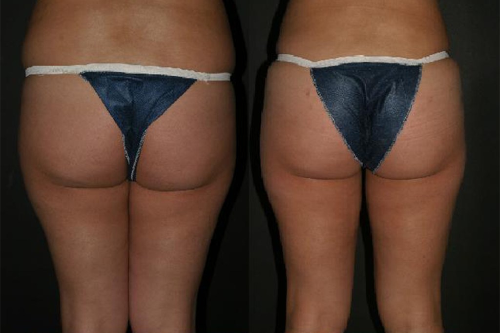 Before and after comparison of a woman's buttock augmentation and lipoinjection procedure